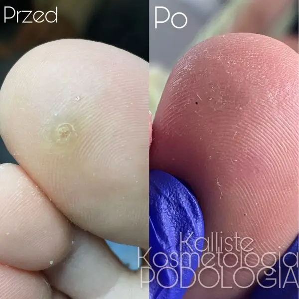 Zabieg podologiczny palców stóp Kalliste Sędziszów Małopolski