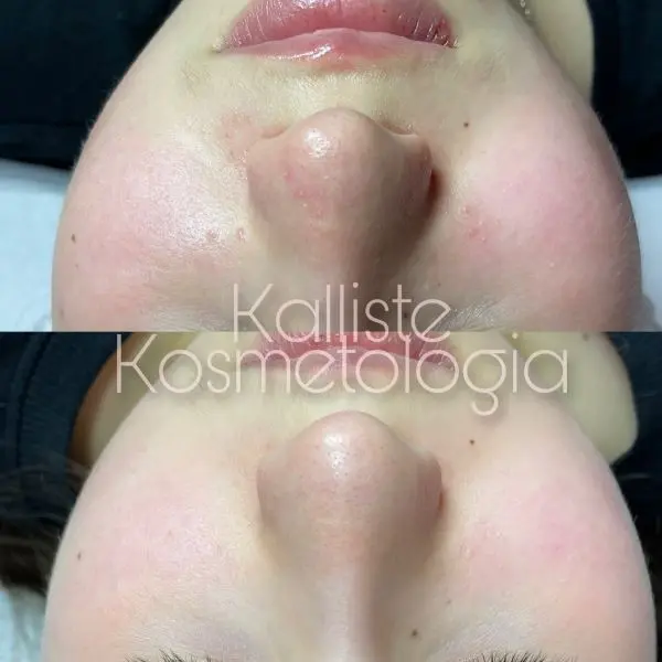 Efekty zabiegów Dermaquest – wygładzenie i odmłodzenie skóry