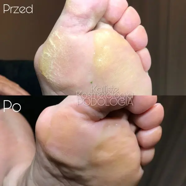 Podologia przed i po zabiegu Kalliste Sędziszów Małopolski