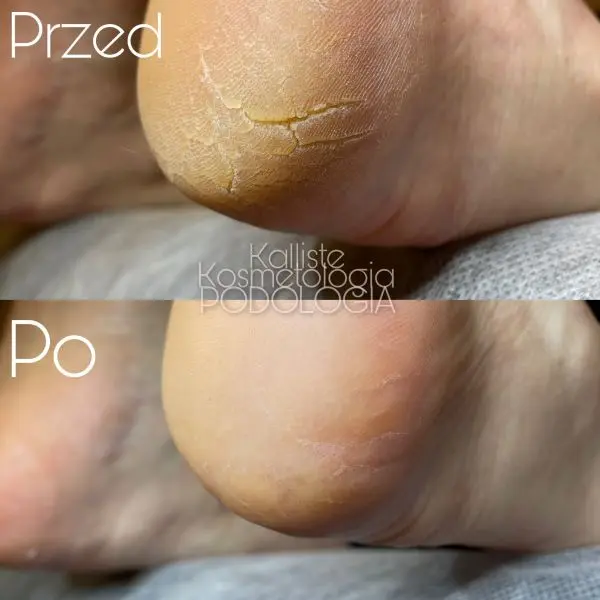 Podologia przed i po zabiegu Kalliste Sędziszów Małopolski