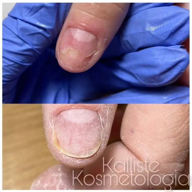 Podologia – opracowanie paznokcia Kalliste Sędziszów Małopolski