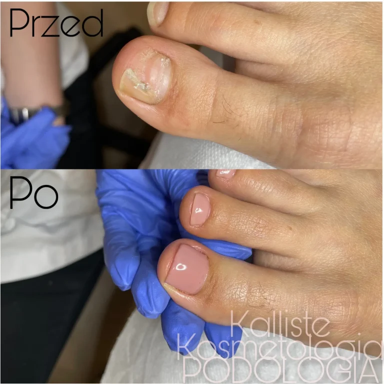 Efekt przed i po zabiegu podologicznym deformacji paznokcia Kalliste w Rzeszowie