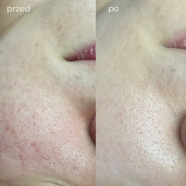 Efekty radiofrekwencji mikroigłowej przed i po