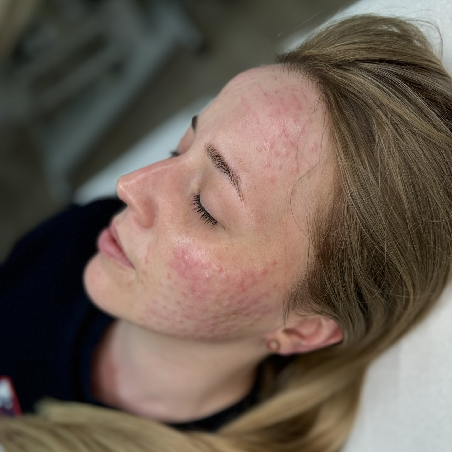 Skóra po mezoterapii mikroigłowej Kalliste Sędziszów Małopolski