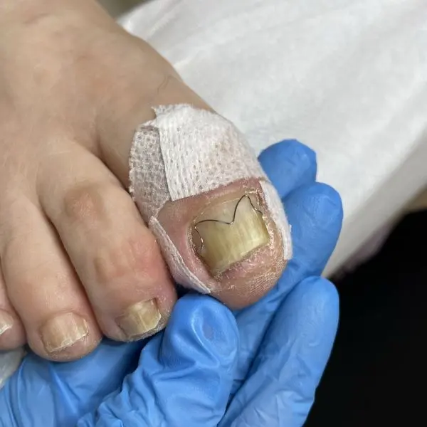 Zabieg podologiczny w salonie Kalliste Sędziszów Małopolski