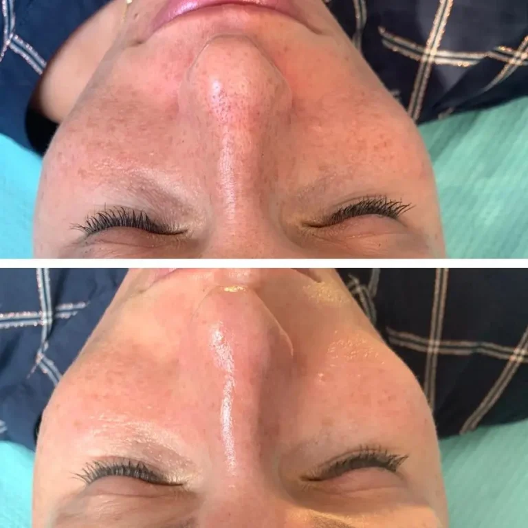 Efekt przed i po zabiegu na twarz wykonane w Rzeszowie