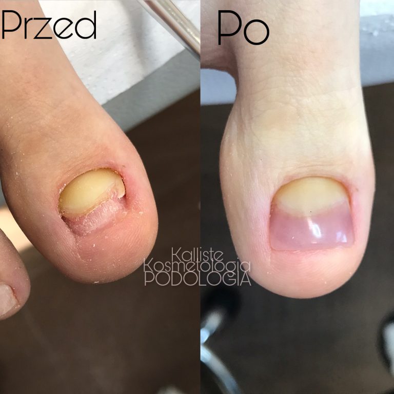 Efekt przed i po leczeniu deformacji paznokcia w salonie kosmologicznym w Sędziszowie Małopolskim