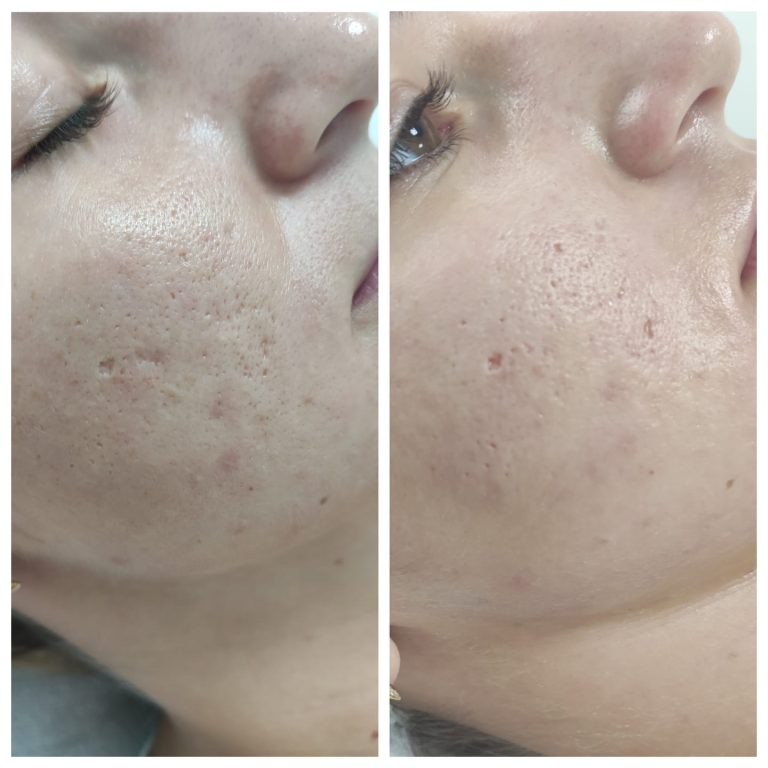 Efekt przed i po redukcji blizn po trądzikowym w Rzeszowie