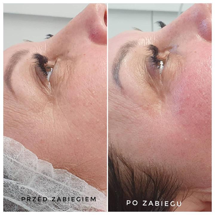 Efekt przed i po terapii kosmetologicznej