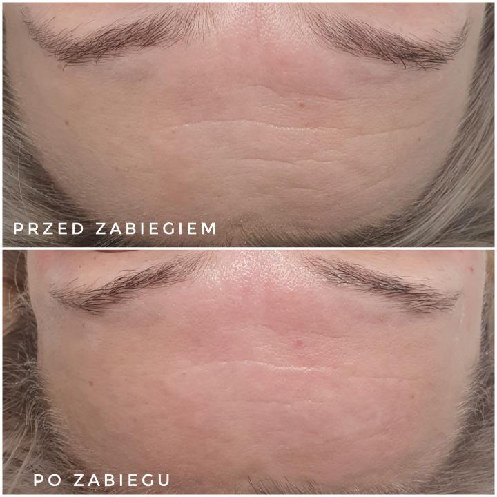 Efekt przed i po zabiegu redukcji zmarszczek w Rzeszowie