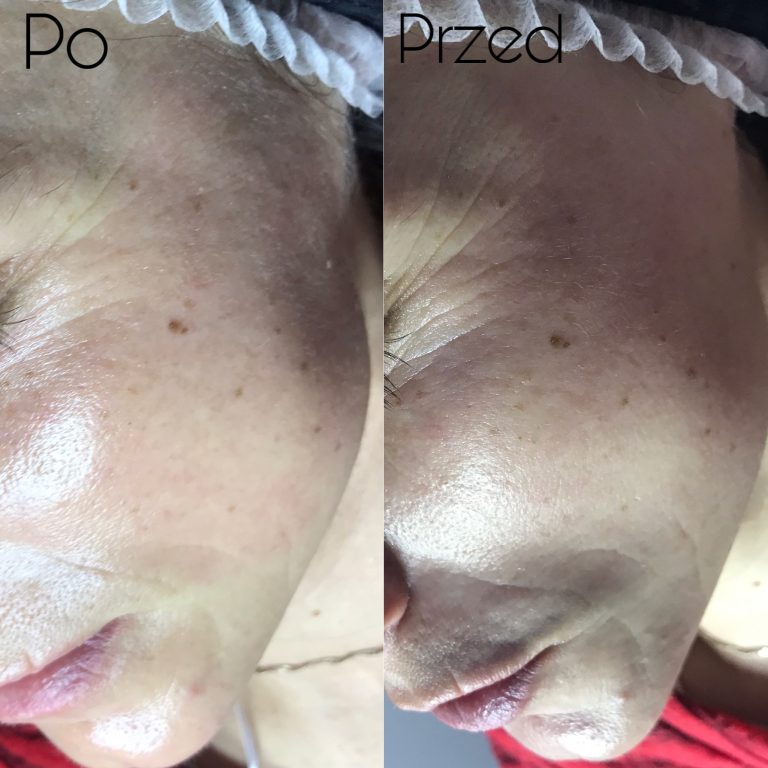 Efekt przed i po zabiegu redukcji zmarszczek w Rzeszowie